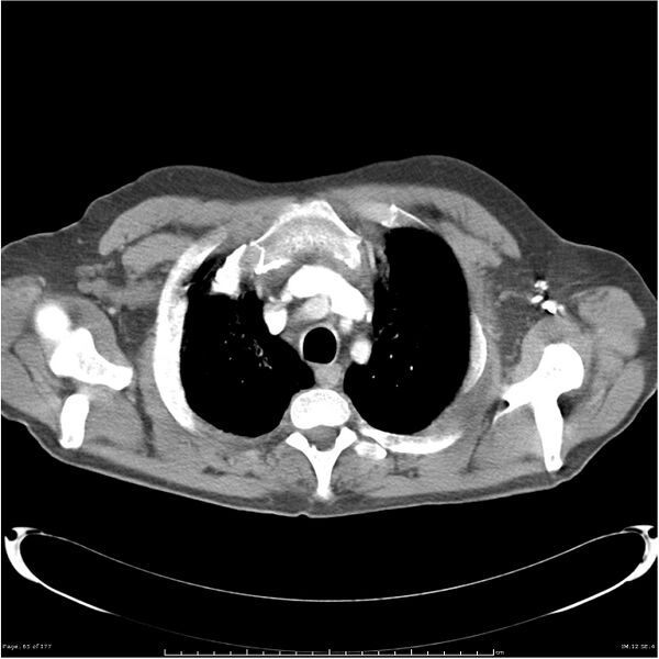 File:Atypical pneumonia - Q fever (Radiopaedia 21993-21989 C+ arterial phase 7).jpg