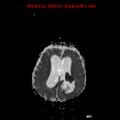 Atypical teratoid rhabdoid tumor (Radiopaedia 10712-11183 Axial ADC 6).jpg