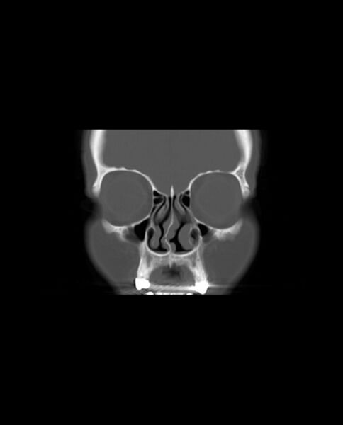 File:Automastoidectomy with labyrinthine fistula (Radiopaedia 84143-99411 Coronal non-contrast 17).jpg