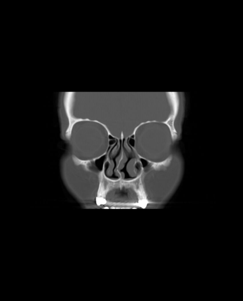Automastoidectomy with labyrinthine fistula (Radiopaedia 84143-99411 Coronal non-contrast 17).jpg