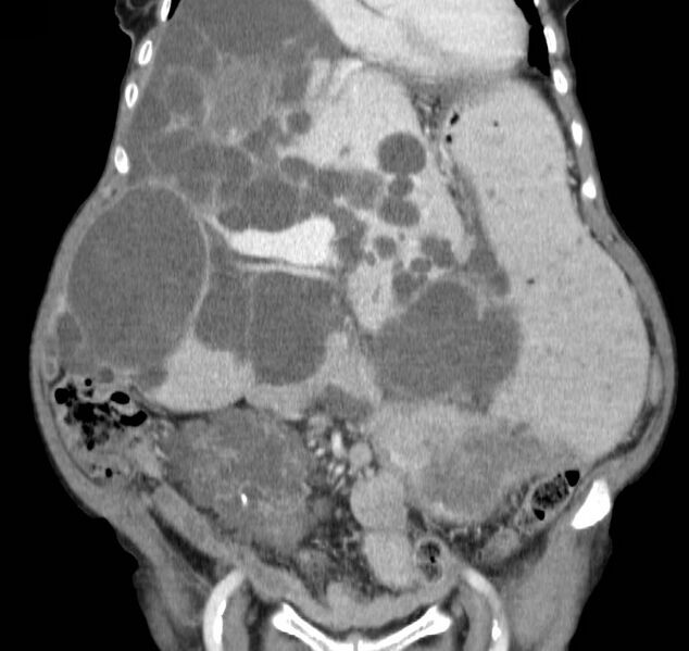 File:Autosomal dominant polycystic kidney disease (Radiopaedia 16777-16490 B 16).jpg