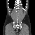Autosomal dominant polycystic kidney disease (Radiopaedia 36539-38101 C 59).jpg