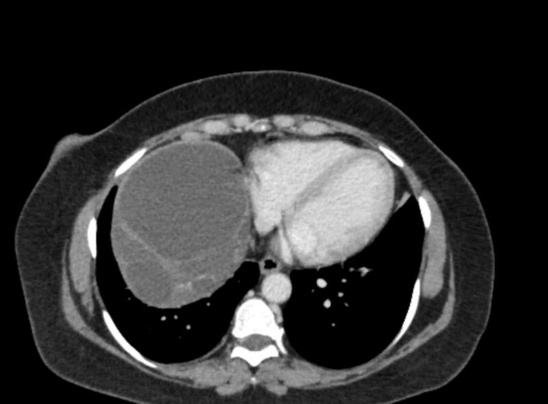 File:Autosomal dominant polycystic kidney disease (Radiopaedia 57124-64017 A 13).jpg