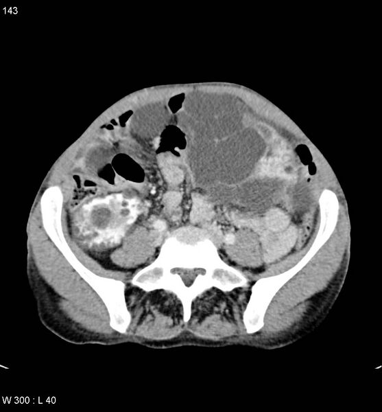 File:Autosomal dominant polycystic kidney disease with extensive hepatic involvement (Radiopaedia 5204-6971 B 20).jpg