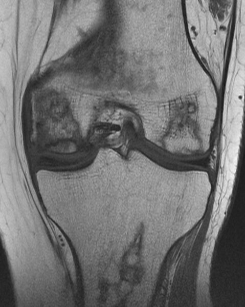 File:Avascular necrosis of the knee (Radiopaedia 2583-6277 Coronal T1 1).jpg
