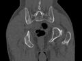 Avascular necrosis of the left hip (Radiopaedia 75068-86125 Coronal bone window 81).jpg
