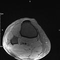 Avulsion fracture of the fibular head (Radiopaedia 74804-85808 Axial PD fat sat 37).jpg