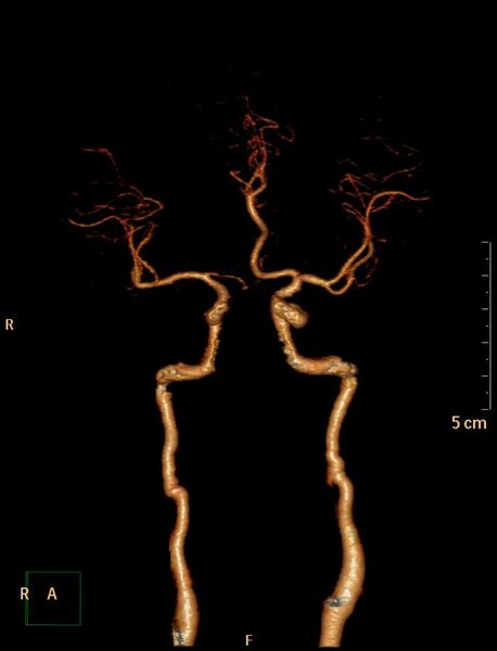 File:Azygos anterior cerebral artery (Radiopaedia 30805-31512 C 1).jpg