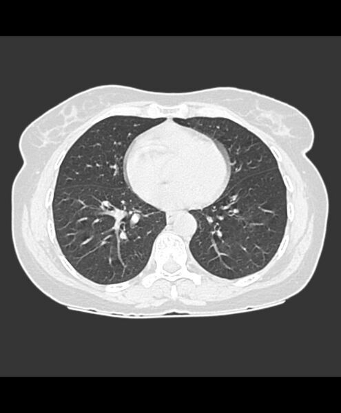 File:Azygos fissure and azygos lobe (Radiopaedia 41841-44832 Axial lung window 8).jpg