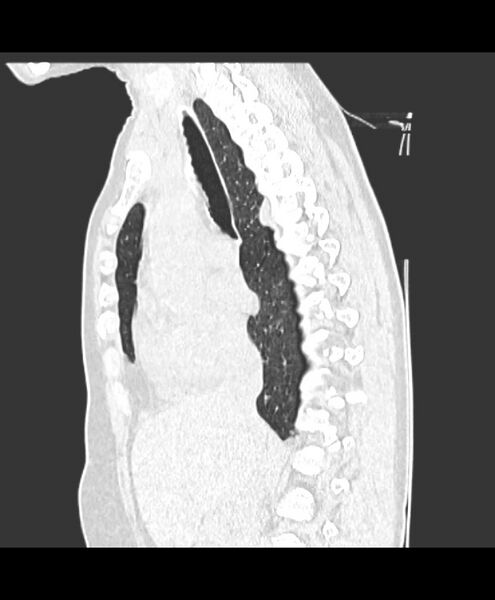 File:Azygos fissure and azygos lobe (Radiopaedia 41841-44832 Sagittal lung window 10).jpg