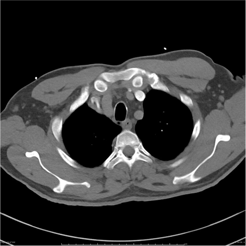 Azygos venous system anatomy (CT pulmonary angiography) (Radiopaedia 25928-26077 Axial C+ CTPA 14).jpg