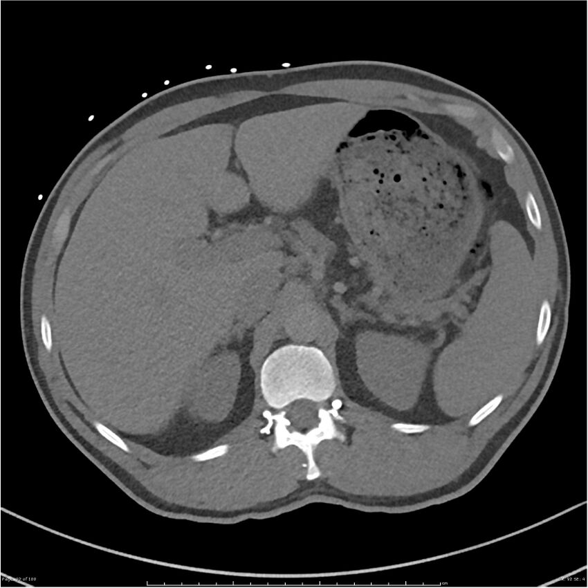 Azygos venous system anatomy (CT pulmonary angiography) (Radiopaedia 25928-26077 Axial C+ CTPA 92).jpg