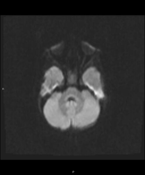 File:Basal ganglia and parenchymal ischemia (Radiopaedia 45818-50084 Axial DWI 8).jpg