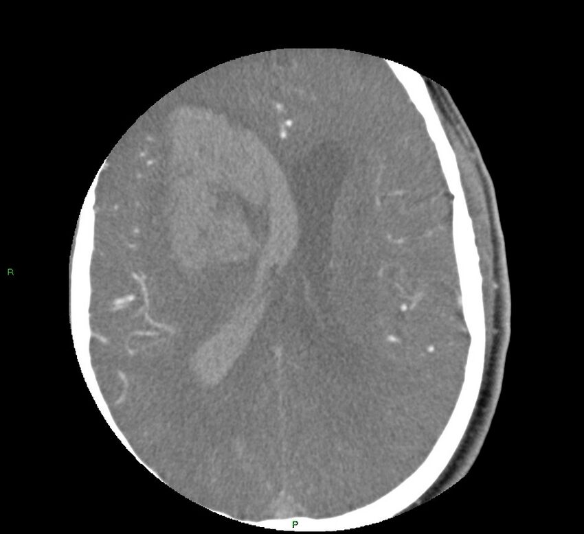 Basal ganglia hemorrhage (Radiopaedia 58763-65985 D 113).jpg