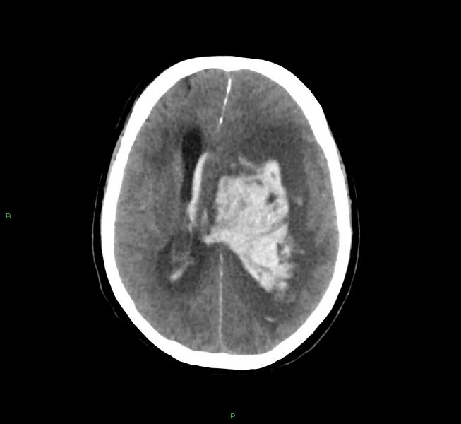 File:Basal ganglia hemorrhage (Radiopaedia 58775-66008 Axial non-contrast 28).jpg