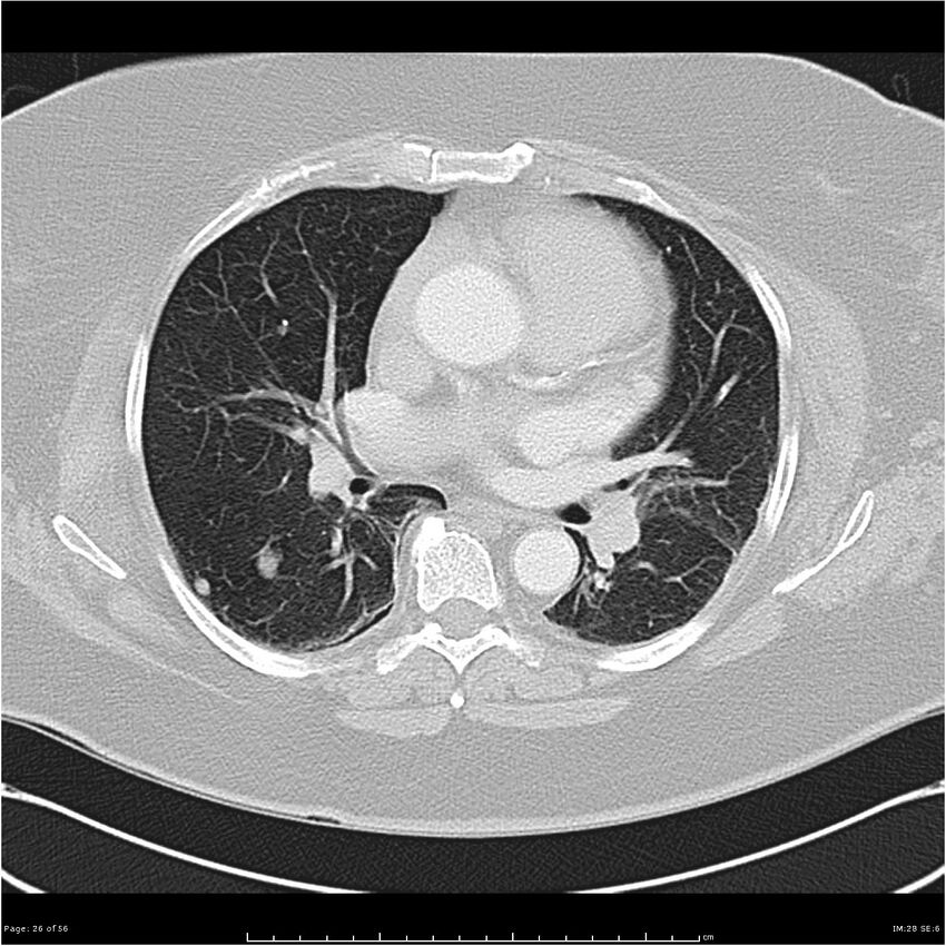 Benign metastasizing leiomyoma (Radiopaedia 26803-26962 Axial lung window 26).jpg