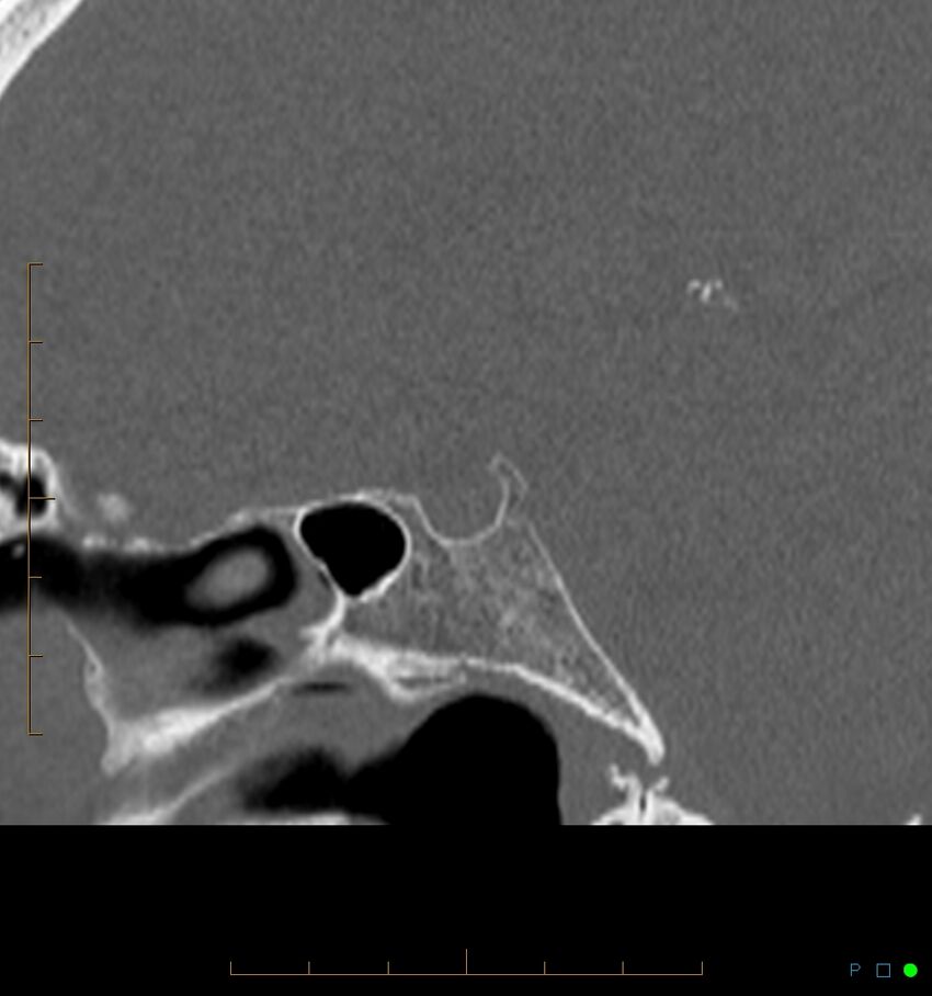 Benign notochordal cell tumor (probable) (Radiopaedia 65475-74546 Sagittal bone window 25).jpg