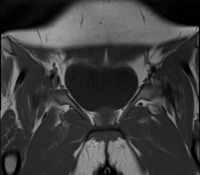 File:Bicornuate uterus (Radiopaedia 71214-81511 Coronal T1 28).jpg
