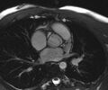 Bicuspid aortic valve with aortic coarctation (Radiopaedia 29895-30410 Oblique SSFP Cine 5).jpg