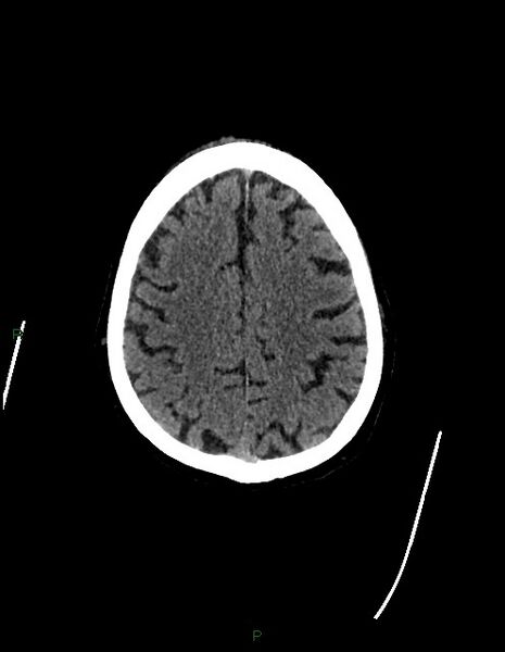 File:Bilateral acute middle cerebral artery territory infarcts (Radiopaedia 77319-89401 Axial non-contrast 67).jpg