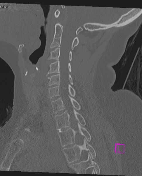 File:Bilateral atlanto-occipital assimilation (Radiopaedia 28350-28603 Sagittal bone window 35).jpg