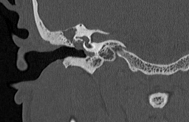 File:Bilateral cholesteatoma (Radiopaedia 54898-61172 Coronal bone window 38).jpg