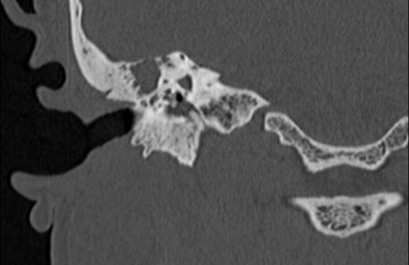 File:Bilateral cholesteatoma (Radiopaedia 54898-61172 Coronal bone window 45).jpg