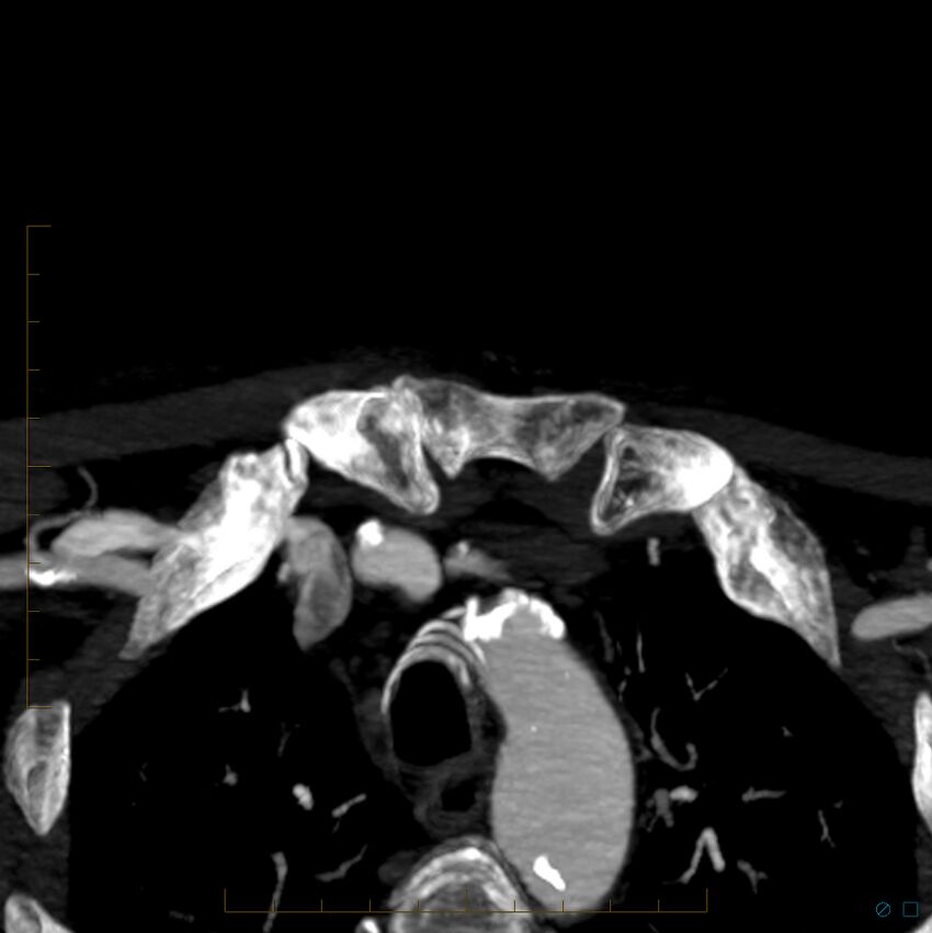 Bilateral chronic common carotid occlusion (Radiopaedia 50849-56362 D 57).jpg