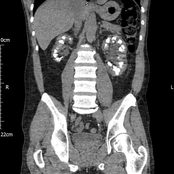 File:Bilateral medullary nephrocalcinosis with ureteric calculi (Radiopaedia 71269-81569 Coronal non-contrast 42).jpg