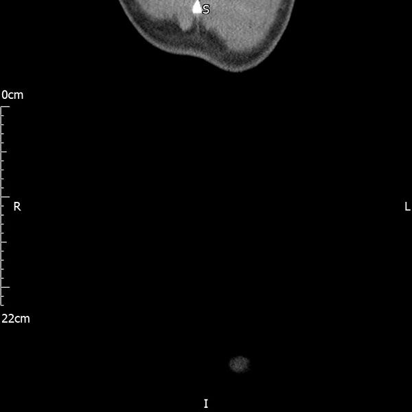 File:Bilateral medullary nephrocalcinosis with ureteric calculi (Radiopaedia 71269-81569 Coronal non-contrast 81).jpg