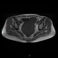 Bilateral ovarian fibroma (Radiopaedia 44568-48293 Axial T1 15).jpg