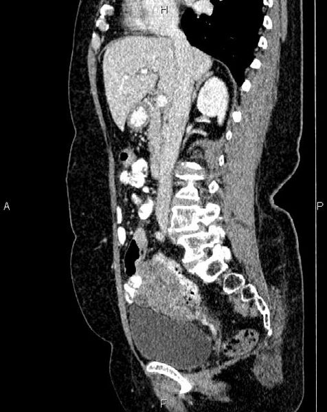 File:Bilateral ovarian serous cystadenocarcinoma (Radiopaedia 86062-101989 E 34).jpg