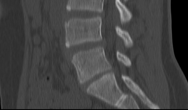 File:Bilateral pars defect (Radiopaedia 26691-26846 Sagittal bone window 35).jpg