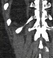 Bile leak from accessory duct(s) of Luschka post cholecystectomy (Radiopaedia 40736-43389 B 67).jpg