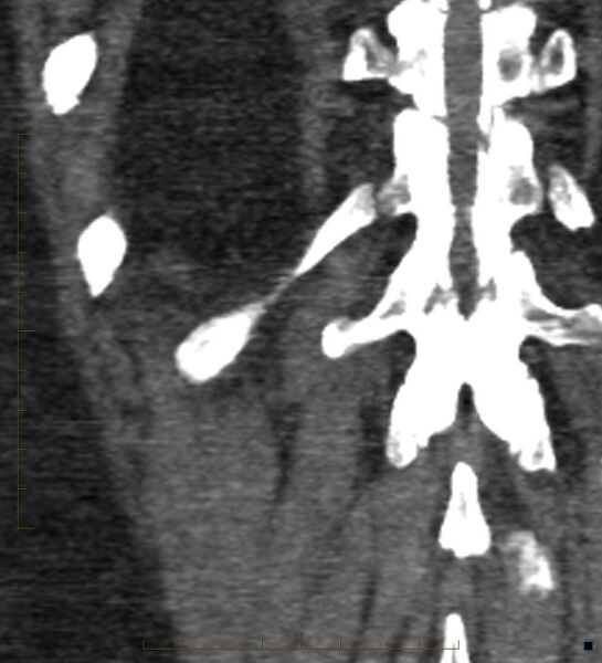 File:Bile leak from accessory duct(s) of Luschka post cholecystectomy (Radiopaedia 40736-43389 B 67).jpg