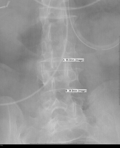File:Block vertebra (Radiopaedia 35741-37280 B 1).jpg