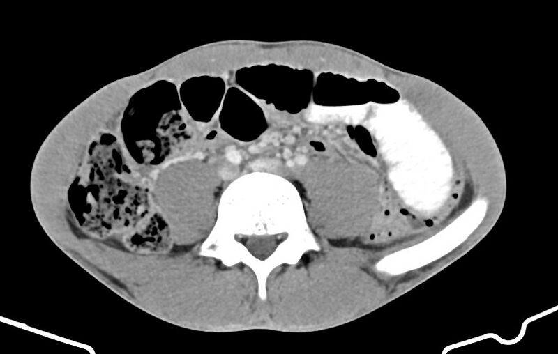 File:Blunt injury to the small bowel (Radiopaedia 74953-85987 A 118).jpg