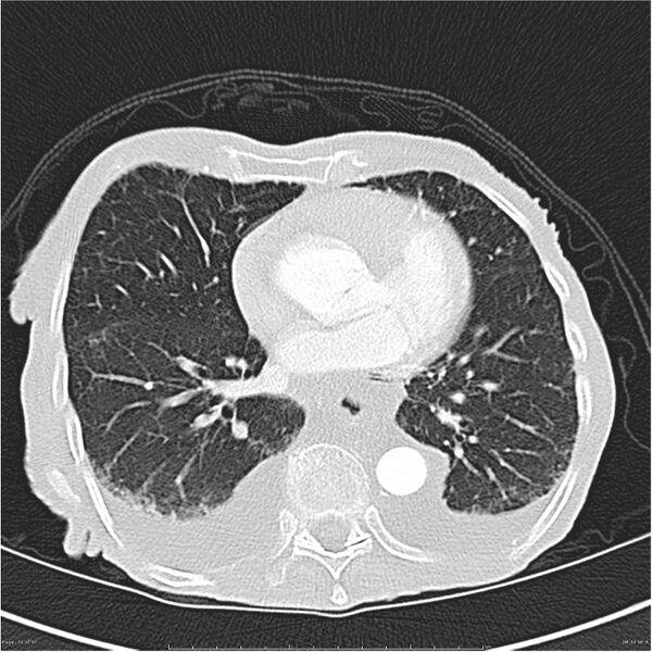 File:Boerhaave syndrome (Radiopaedia 26240-26362 Axial lung window 31).jpg