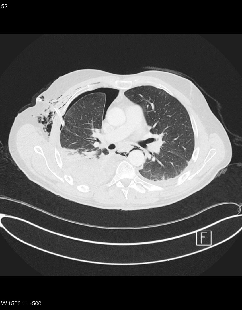 Boerhaave syndrome with tension pneumothorax (Radiopaedia 56794-63605 Axial lung window 25).jpg