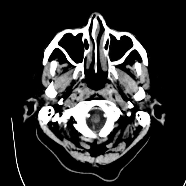 File:Brain Pantopaque remnants (Radiopaedia 78403-91048 Axial non-contrast 16).jpg