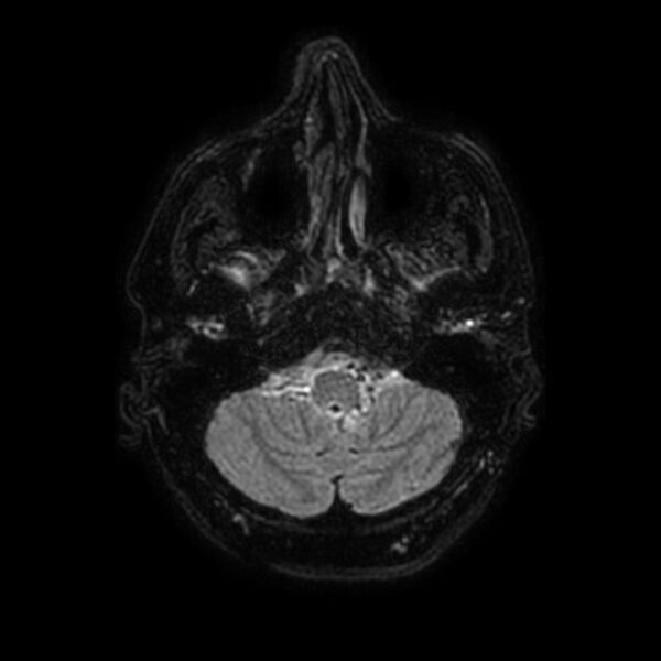 File:Brain abscess complicated by intraventricular rupture and ventriculitis (Radiopaedia 82434-96577 Axial FLAIR 8).jpg