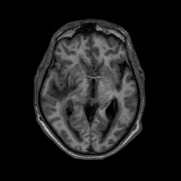 File:Brain abscess complicated by intraventricular rupture and ventriculitis (Radiopaedia 82434-96577 Axial T1 31).jpg