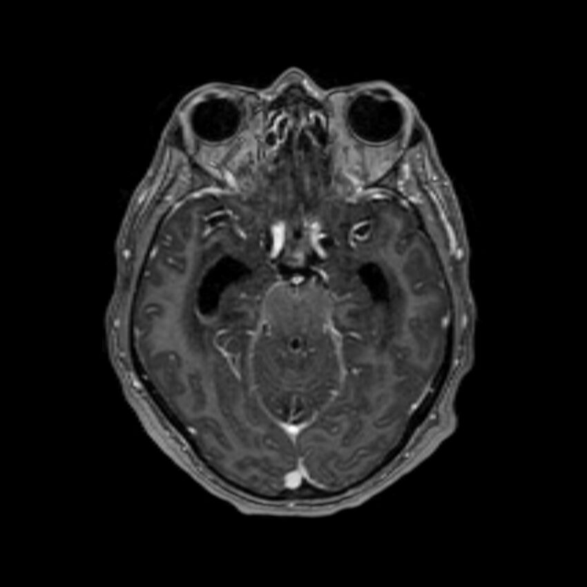 Brain abscess complicated by intraventricular rupture and ventriculitis (Radiopaedia 82434-96577 Axial T1 C+ 23).jpg