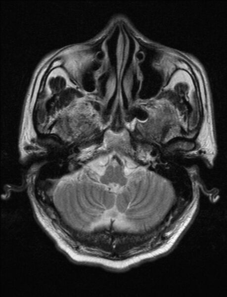 File:Brain abscess with ventriculitis (Radiopaedia 85703-101495 Axial T2 4).jpg