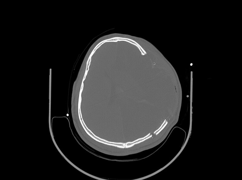 File:Brain injury by firearm projectile (Radiopaedia 82068-96087 A 123).jpg