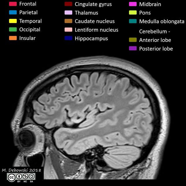 File:Brain lobes - annotated MRI (Radiopaedia 61691-69700 Sagittal 15).JPG