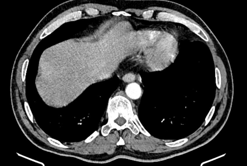 Brain metastases - lung cancer primary (Radiopaedia 75060-86116 B 49).jpg