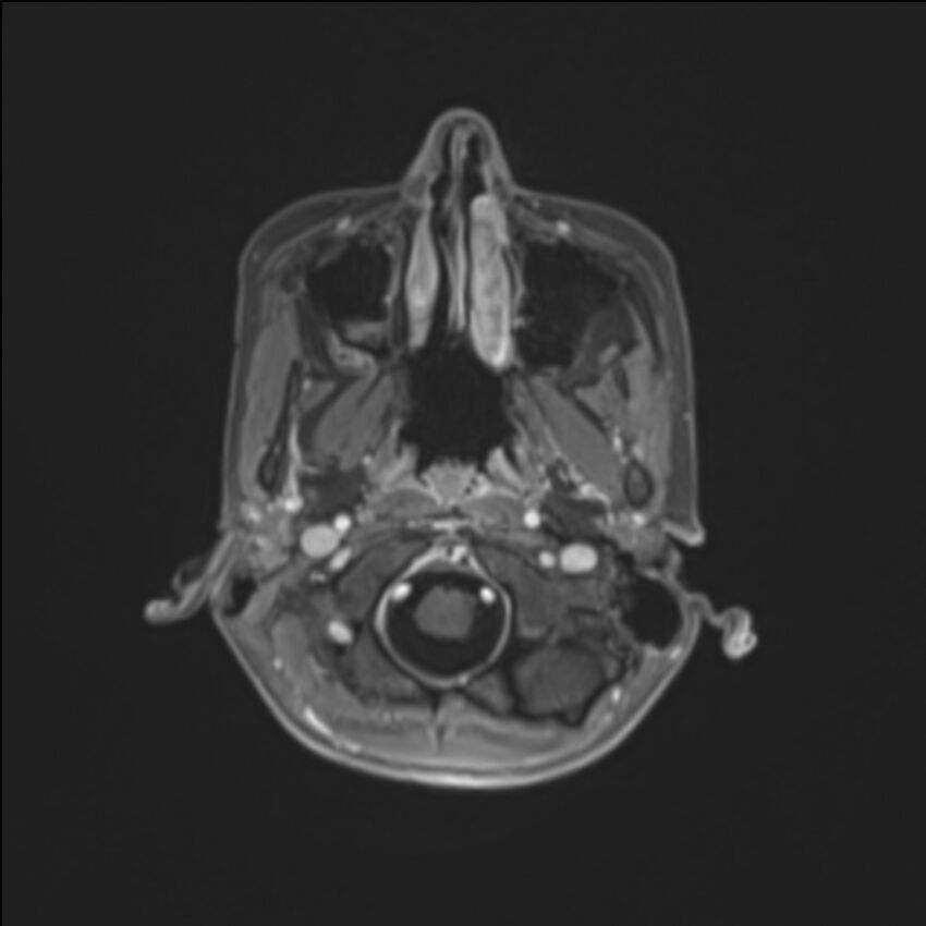 Brainstem glioma (Radiopaedia 70548-80674 Axial T1 C+ 21).jpg
