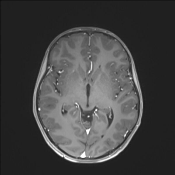 File:Brainstem glioma (Radiopaedia 70548-80674 Axial T1 C+ 79).jpg