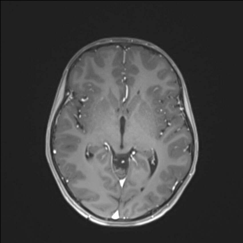 Brainstem glioma (Radiopaedia 70548-80674 Axial T1 C+ 79).jpg